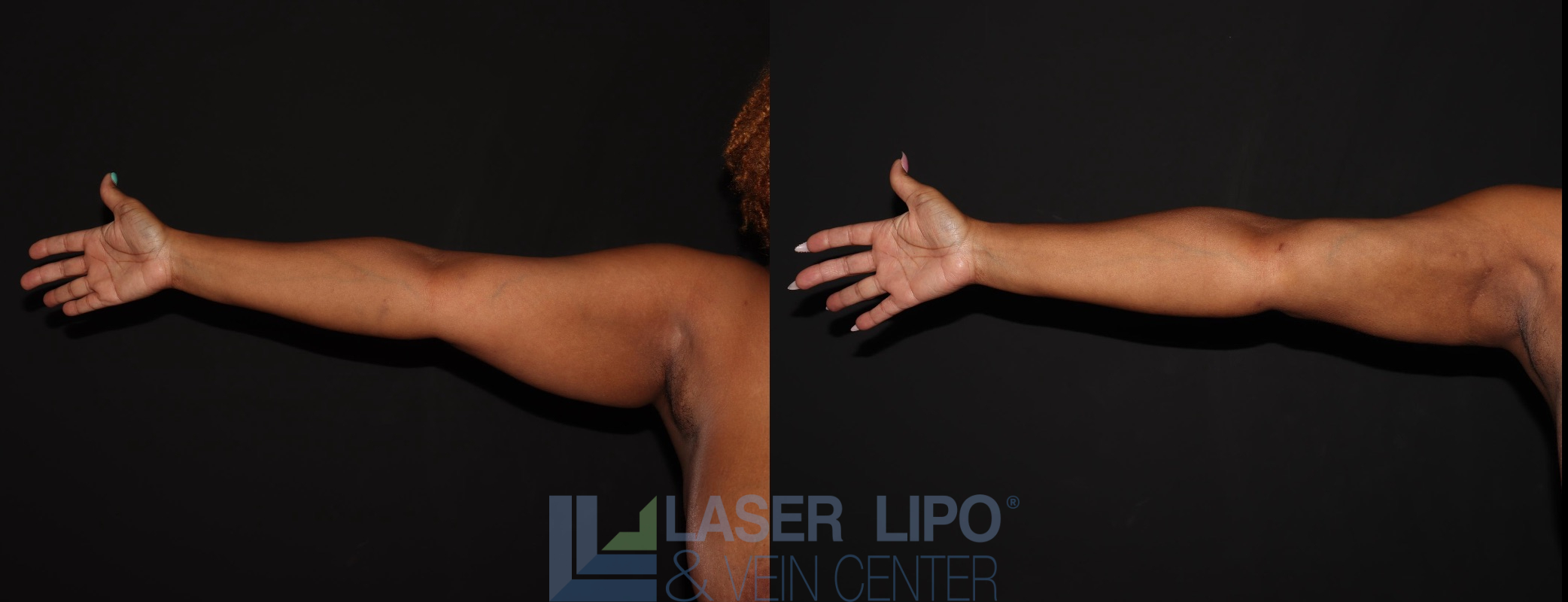 Before and After Image: Liposuction – Arms - front